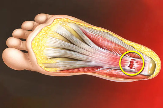 How Does Heel Pain Happen? Causes of Plantar Fasciitis, Heel Pain & Foot Pain